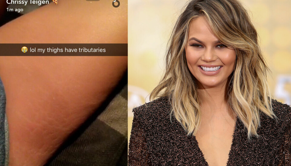 Chrissy Teigen visar upp sina bristningar – hyllas i sociala medier