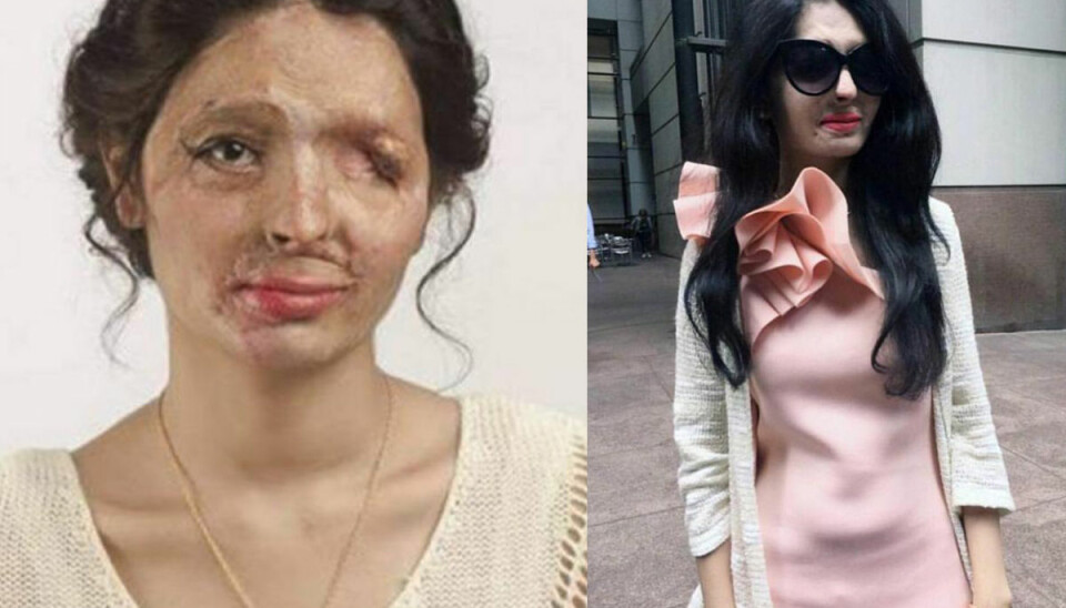 Överlevde syraattack – nu går hon visning på New York Fashion Week