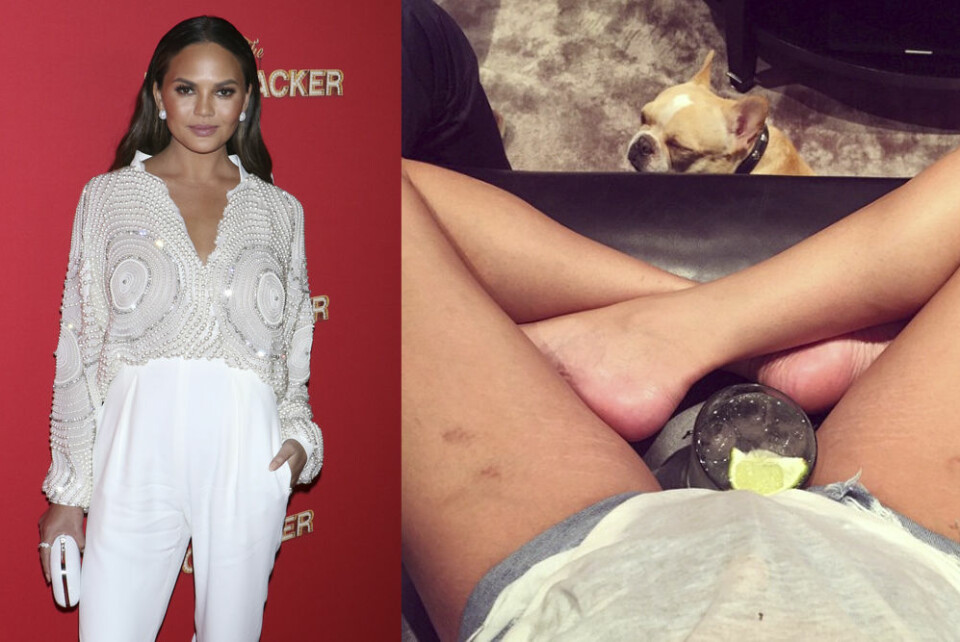 Hyllade Chrissy Teigen ville visa att hennes lår ser ut som alla andras.