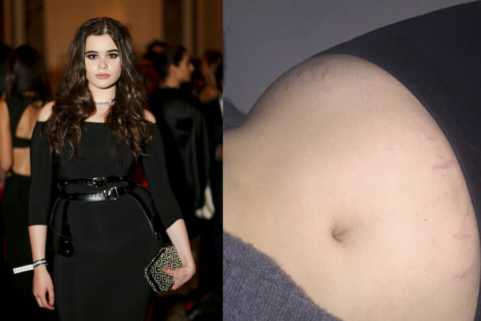 Barbie Ferreira twittrade en bild på sina bristningar.