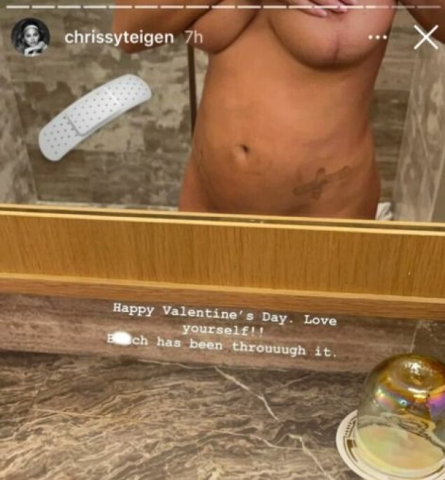 Chrissy Teigens ärliga kroppsbild visar ärren efter operation mot endometrios