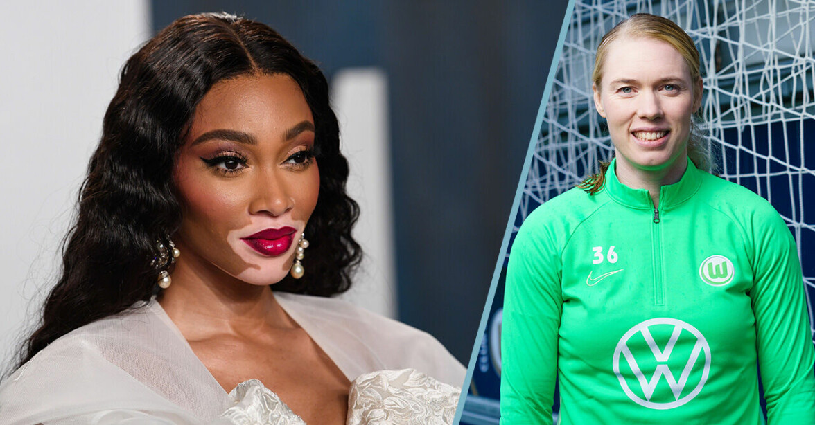 Winnie Harlow – och 5 andra kändisar med vitiligo