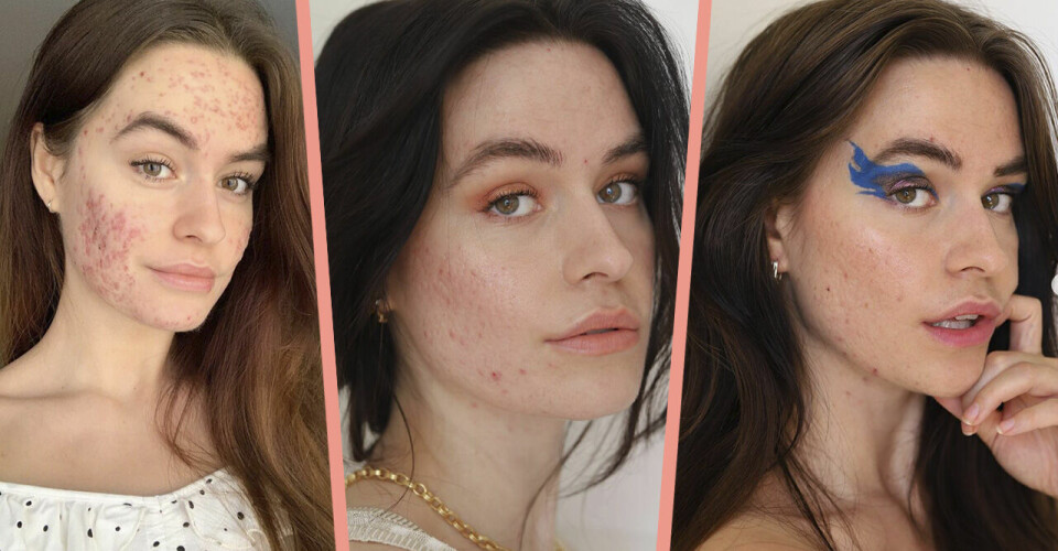 Sofia Grahn isolerade sig på grund av akne – men Instagram blev vändningen