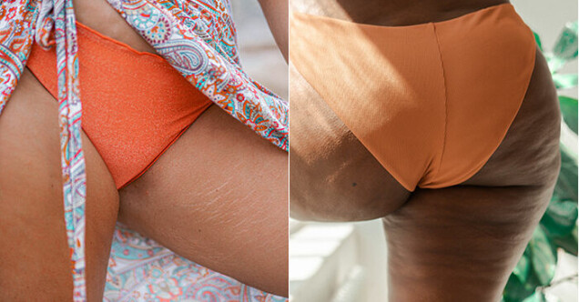 Bristningar och celluliter är något som nästan alla har – ändå har vi svårt att acceptera dem. Bristningar och celluliter är något som nästan alla har – ändå har vi svårt att acceptera dem.